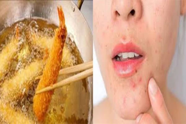 Da mặt bị khô, bong tróc và thiếu ẩm cần được chăm sóc và cấp ẩm đúng cách