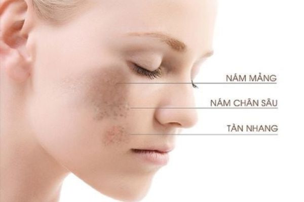 Kem trị nám tàn nhang giúp cải thiện làn da không đều màu và hỗ trợ chăm sóc da hiệu quả